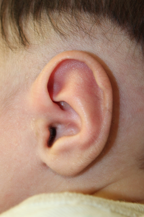 baby ear reshaping