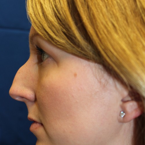 Female Cosmetic Rhinoplasty