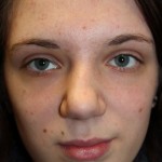 Female Cosmetic Rhinoplasty