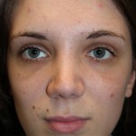 Female Cosmetic Rhinoplasty