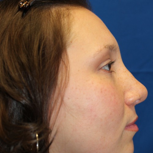 Female Cosmetic Rhinoplasty