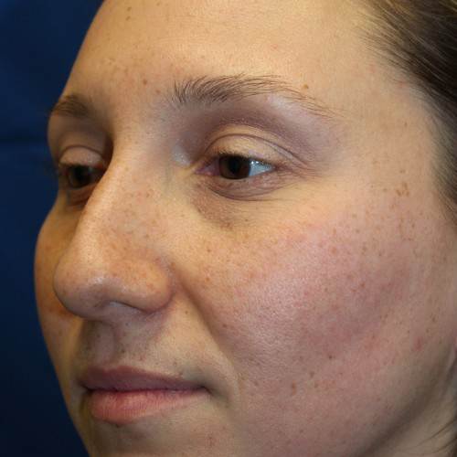 Female Cosmetic Rhinoplasty