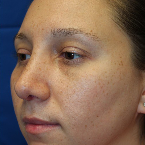 Female Cosmetic Rhinoplasty