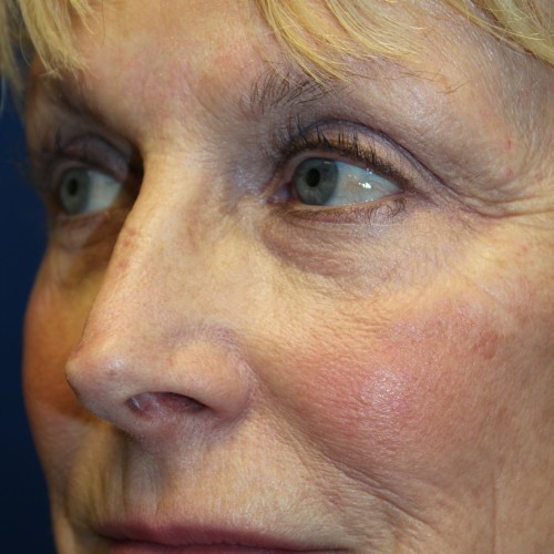 Female Revision Rhinoplasty