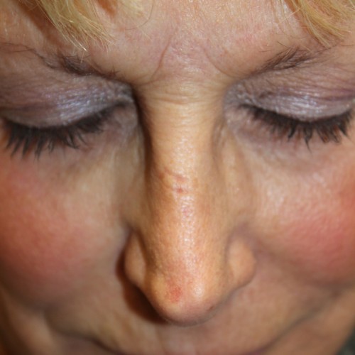 Female Revision Rhinoplasty