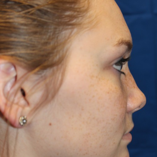 Female Cosmetic Rhinoplasty