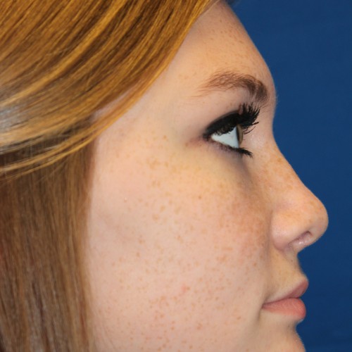 Female Cosmetic Rhinoplasty