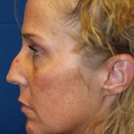 Female Revision Rhinoplasty