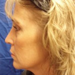 Female Revision Rhinoplasty