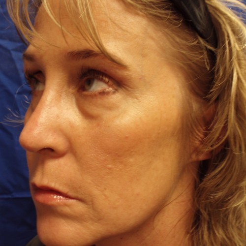 Female Revision Rhinoplasty