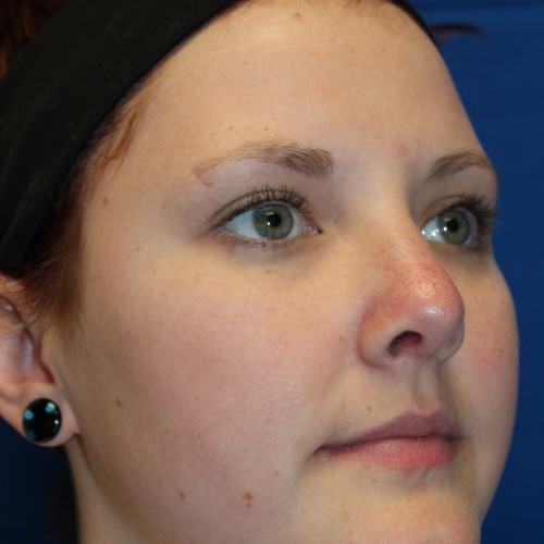 Female Cosmetic Rhinoplasty