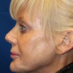 Female Revision Rhinoplasty