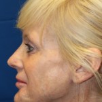 Female Revision Rhinoplasty