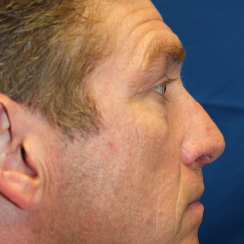 Male Cosmetic Rhinoplasty