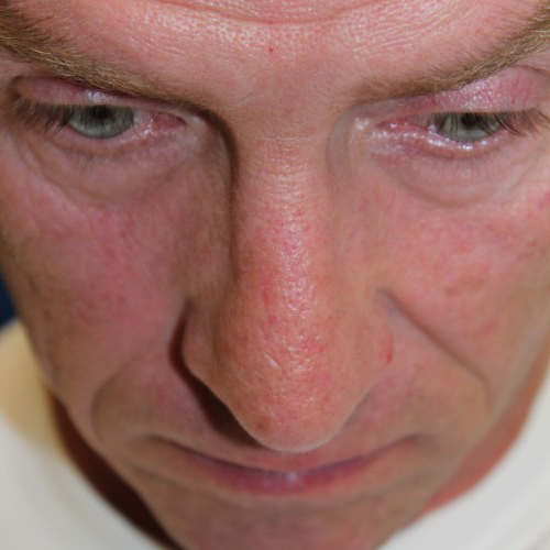 Male Cosmetic Rhinoplasty