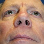 Male Cosmetic Rhinoplasty