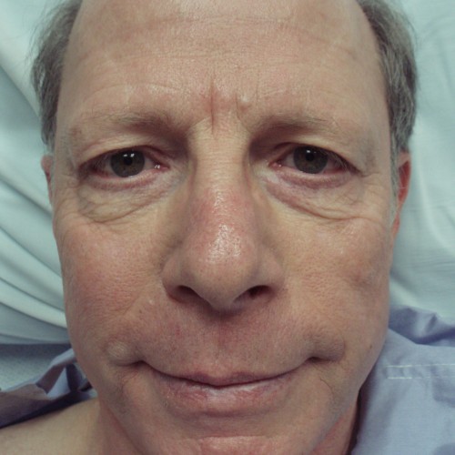 Male Cosmetic Rhinoplasty