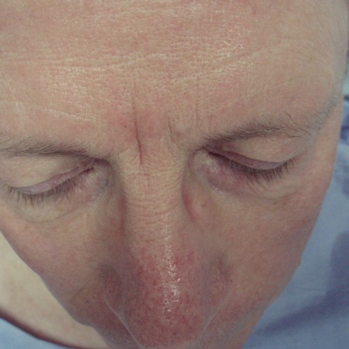 Male Cosmetic Rhinoplasty