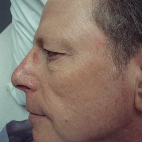 Male Cosmetic Rhinoplasty