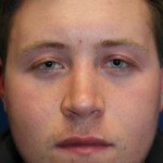 Male Cosmetic Rhinoplasty