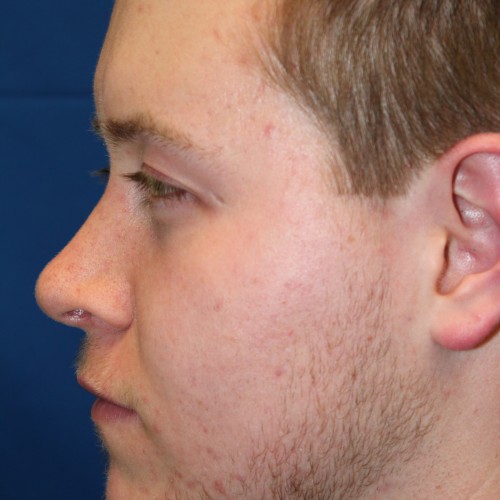 Male Cosmetic Rhinoplasty