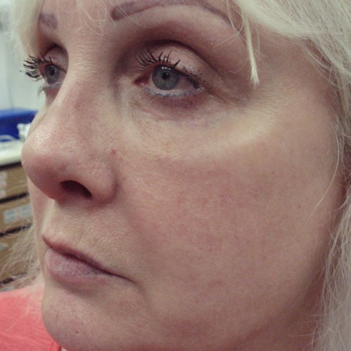 Blepharoplasty