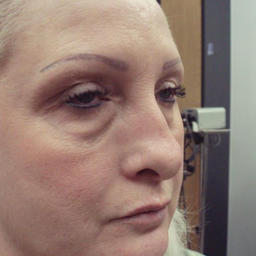 Blepharoplasty