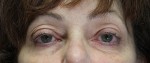 Blepharoplasty