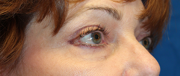 Blepharoplasty