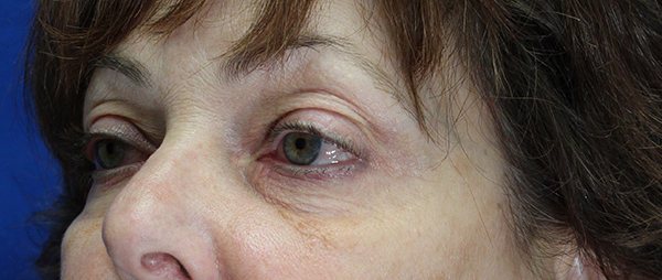 Blepharoplasty