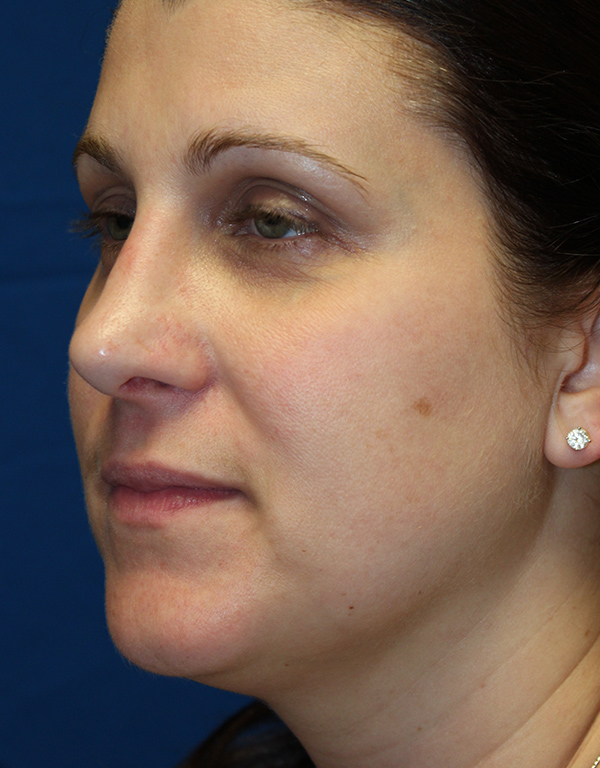 Female Cosmetic Rhinoplasty