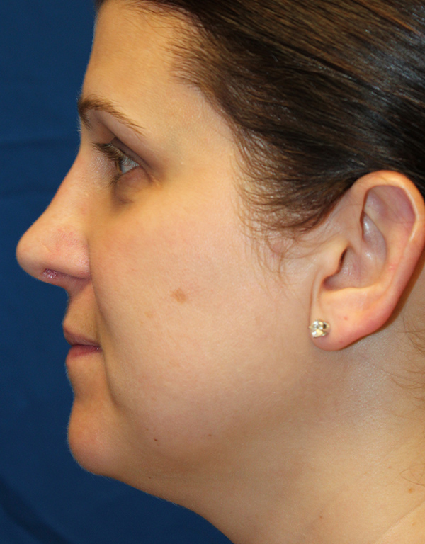 Female Cosmetic Rhinoplasty