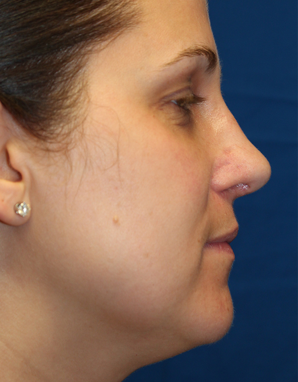 Female Cosmetic Rhinoplasty