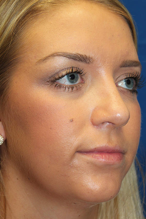 Female Cosmetic Rhinoplasty