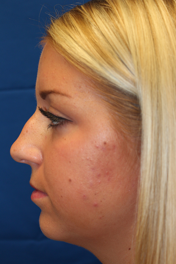 Female Cosmetic Rhinoplasty