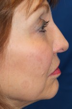 Female Revision Rhinoplasty