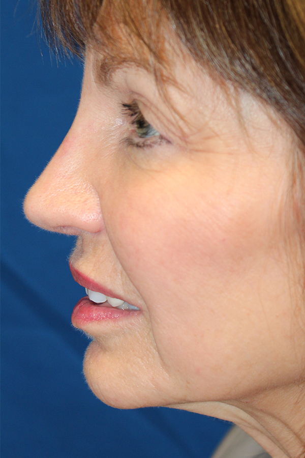 Female Revision Rhinoplasty