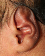 Ear Reshaping