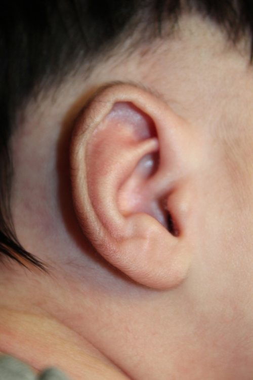 Ear Reshaping