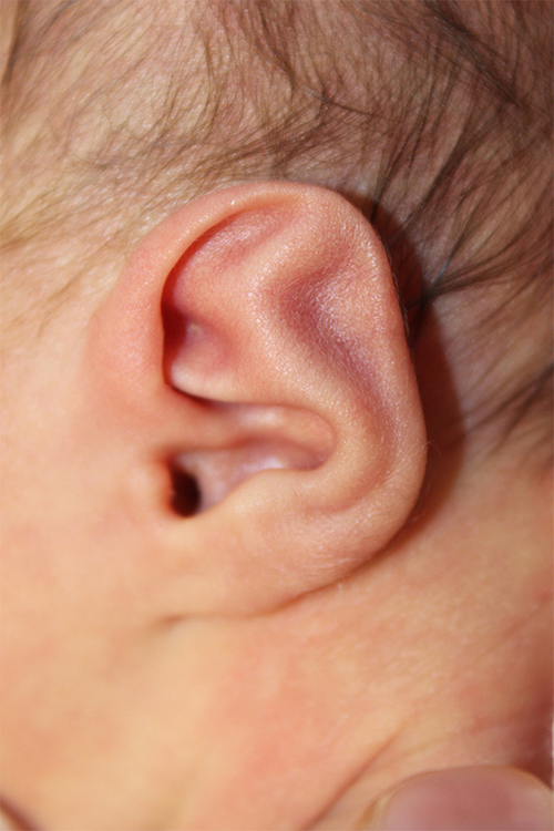 Ear Reshaping