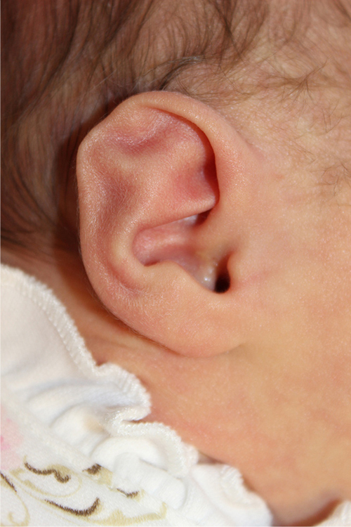 Ear Reshaping