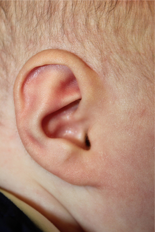 Ear Reshaping