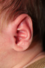 Ear Reshaping