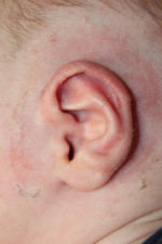 Ear Reshaping