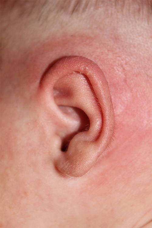 Ear Reshaping