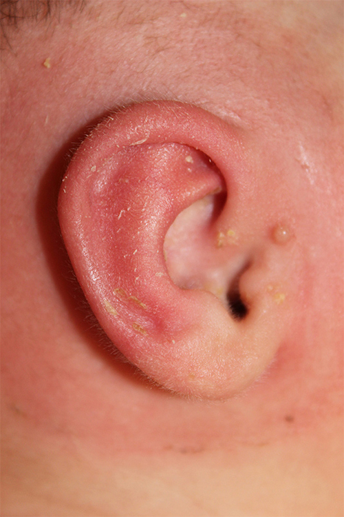 Ear Reshaping