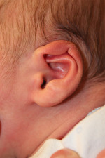 Ear Reshaping