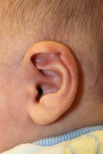 Ear Reshaping