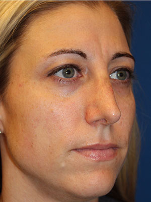 Female Cosmetic Rhinoplasty