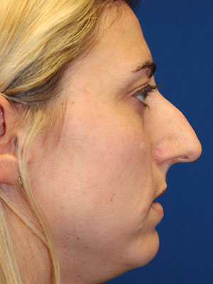 Female Cosmetic Rhinoplasty